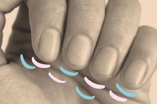 3 علت مهم برای لکه های سفیدرنگ روی ناخن